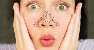 5 astuces naturelles contre les points noirs