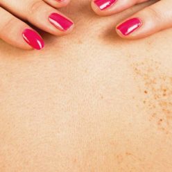 Taches brunes : astuces et remèdes naturels pour les atténuer