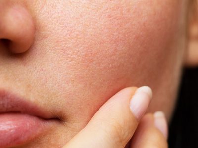 Pores dilatés : routine naturelle pour resserrer son grain de peau