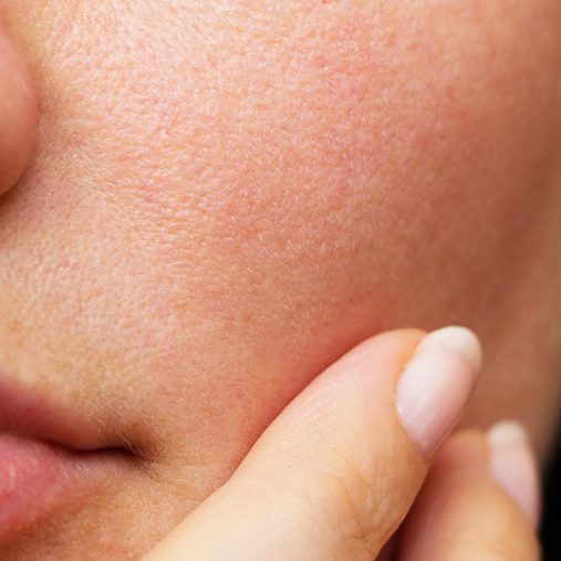 Pores dilatés : routine naturelle pour resserrer son grain de peau