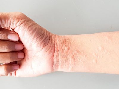 Urticaire : astuces et remèdes naturels pour soulager les crises