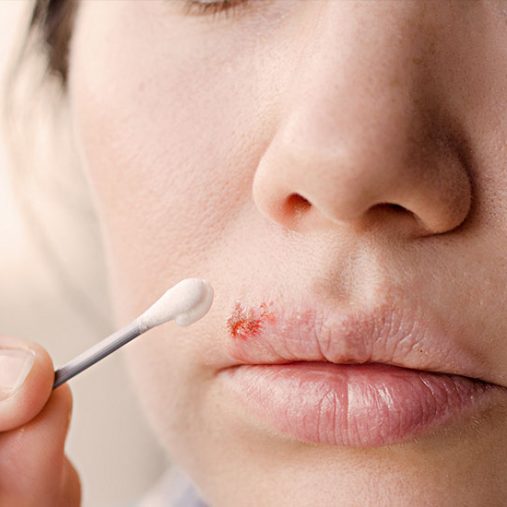 Bouton de fièvre : 5 astuces naturelles pour s’en débarrasser
