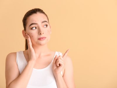 Une peau impeccable : les aliments à éviter pour combattre l'acné