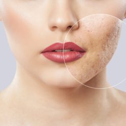 effacer les cicatrices d'acné
