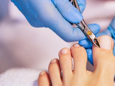 traiter un ongle incarné